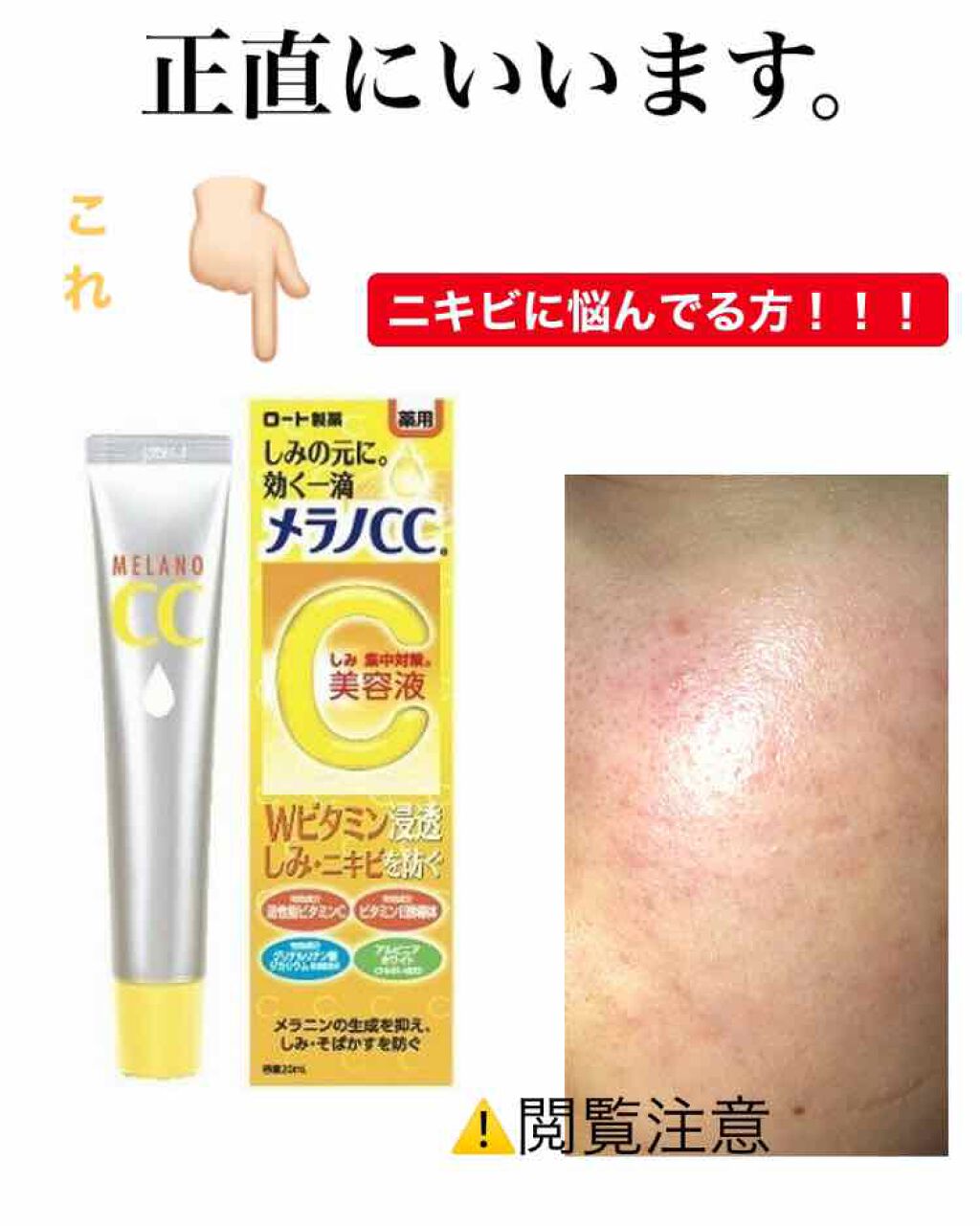 薬用 しみ 集中対策 美容液|メラノCCの辛口レビュー「ニキビに悩んでる方!!メラノCCの美容液っ..」 by ゆな🍒(敏感肌/10代前半) LIPS 薬用 しみ 集中対策 美容液|メラノCCの辛口レビュー「ニキビに悩んでる方!!メラノCCの美容液っ..」 by ゆな🍒(敏感肌/10代前半) LIPS