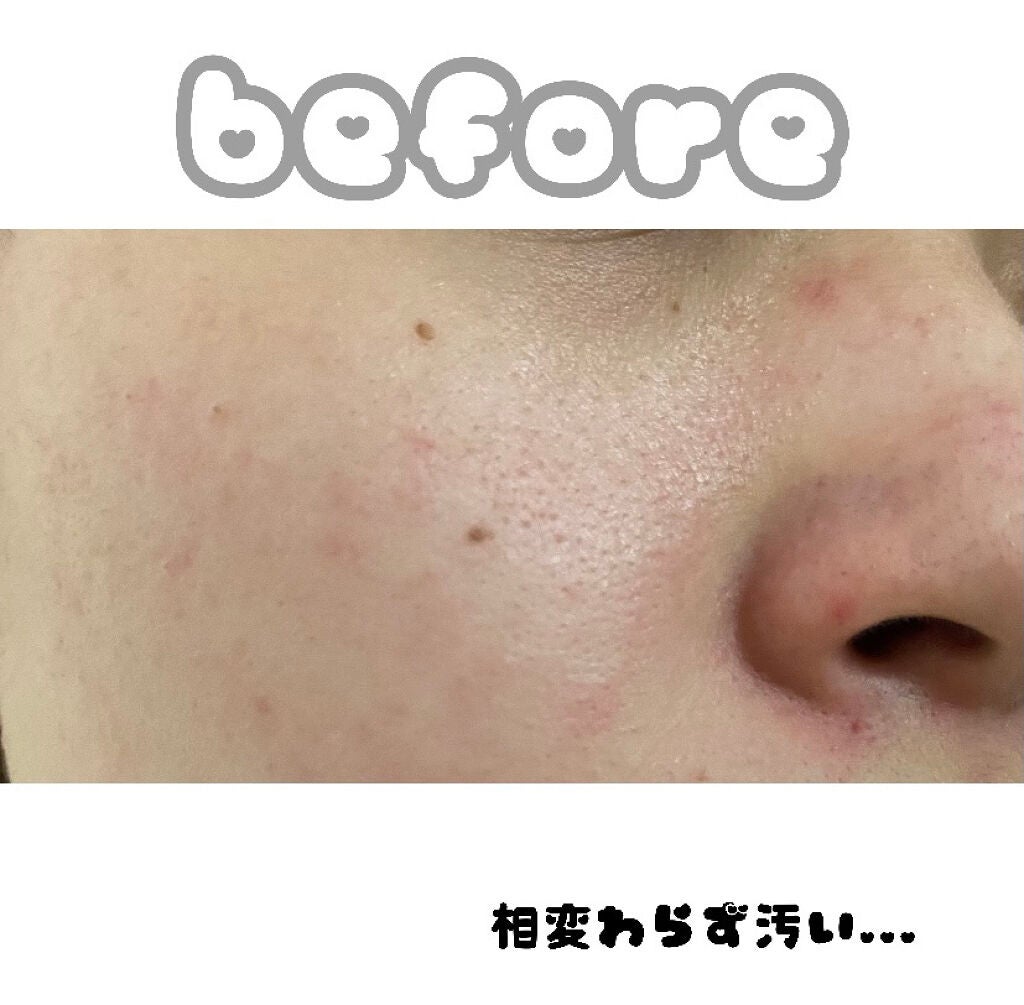 リアルカレンデュラピールオフパック/APRILSKIN/ピーリングを使ったクチコミ(3枚目)