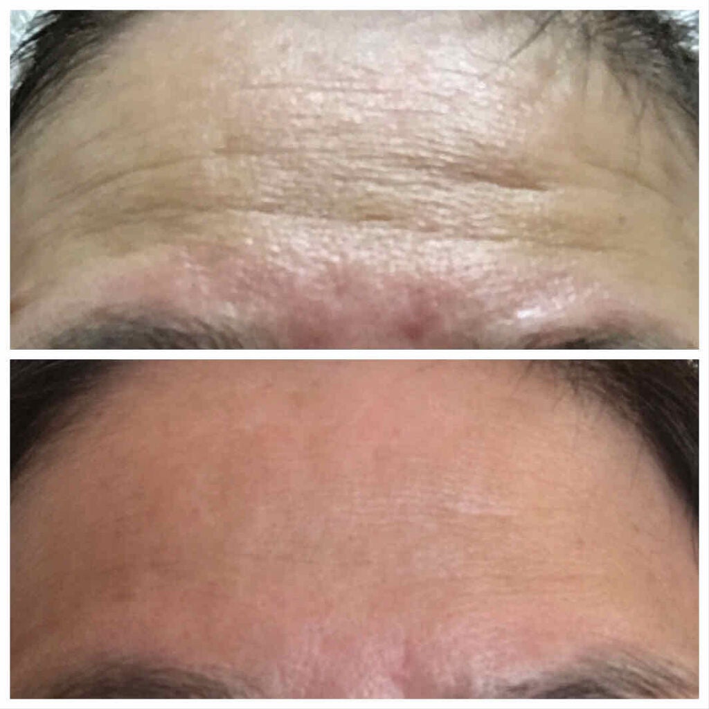 オデコディープパッチ/北の快適工房/シートマスク・パックを使ったクチコミ(2枚目)