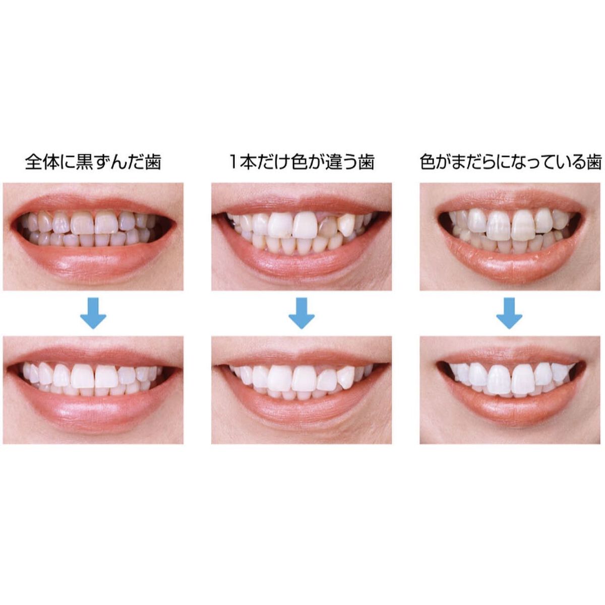 WHITE QUEEN/ハニック・ホワイトラボ/その他オーラルケアを使ったクチコミ(3枚目)