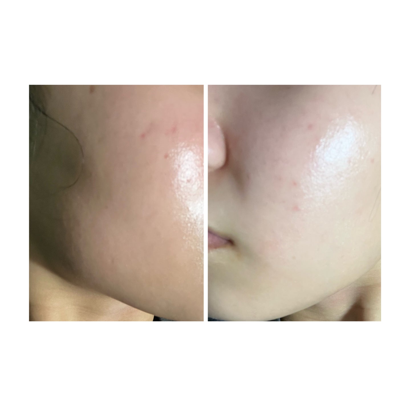 ぽむ on LIPS 「2023.9.13皮膚科に受診 エピデュオとヘパリン処方1枚目..」(5枚目)