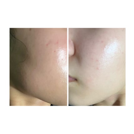 ぽむ on LIPS 「2023.9.13皮膚科に受診 エピデュオとヘパリン処方1枚目..」(5枚目)