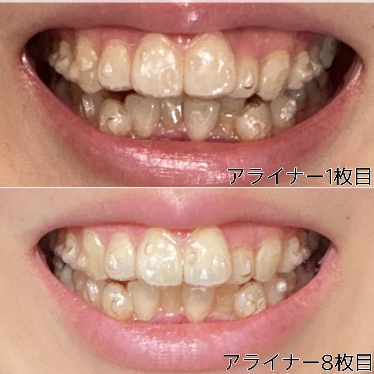 クリニカ スポンジフロス/クリニカ/デンタルフロス・歯間ブラシを使ったクチコミ（3枚目）