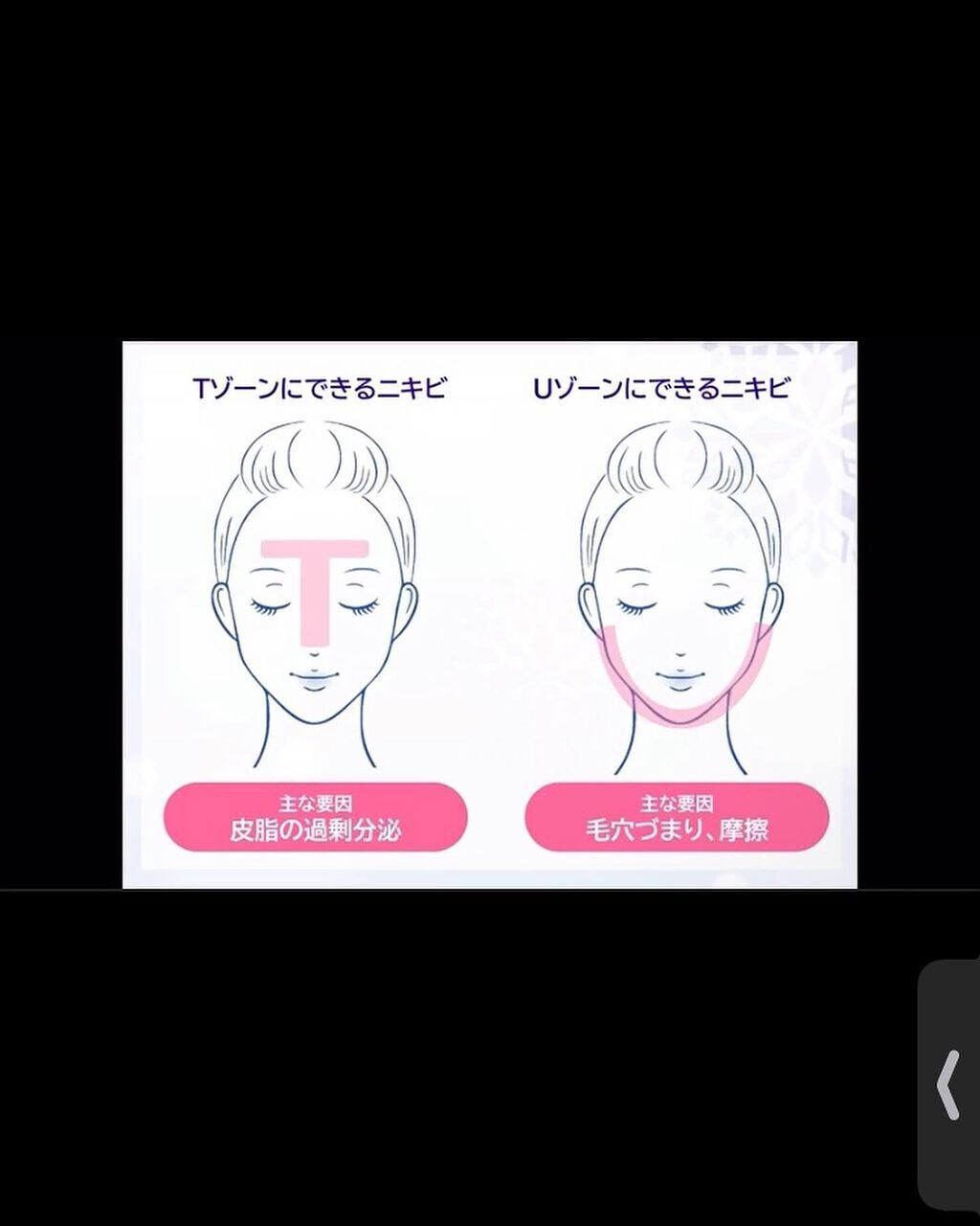 マキロン アクネージュ メディカルクリーム (医薬品) /マキロン/その他を使ったクチコミ(4枚目)