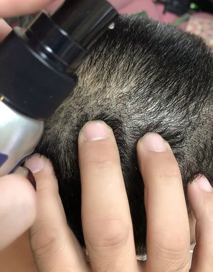 薬用スカルプローション/FORTERO/頭皮ローションを使ったクチコミ(3枚目)