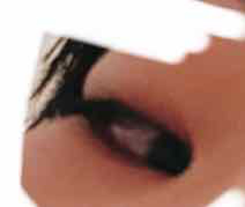 くろず on LIPS 「mediaで腫れてしまったときの画像が出てきました…!(閲覧注..」(3枚目)