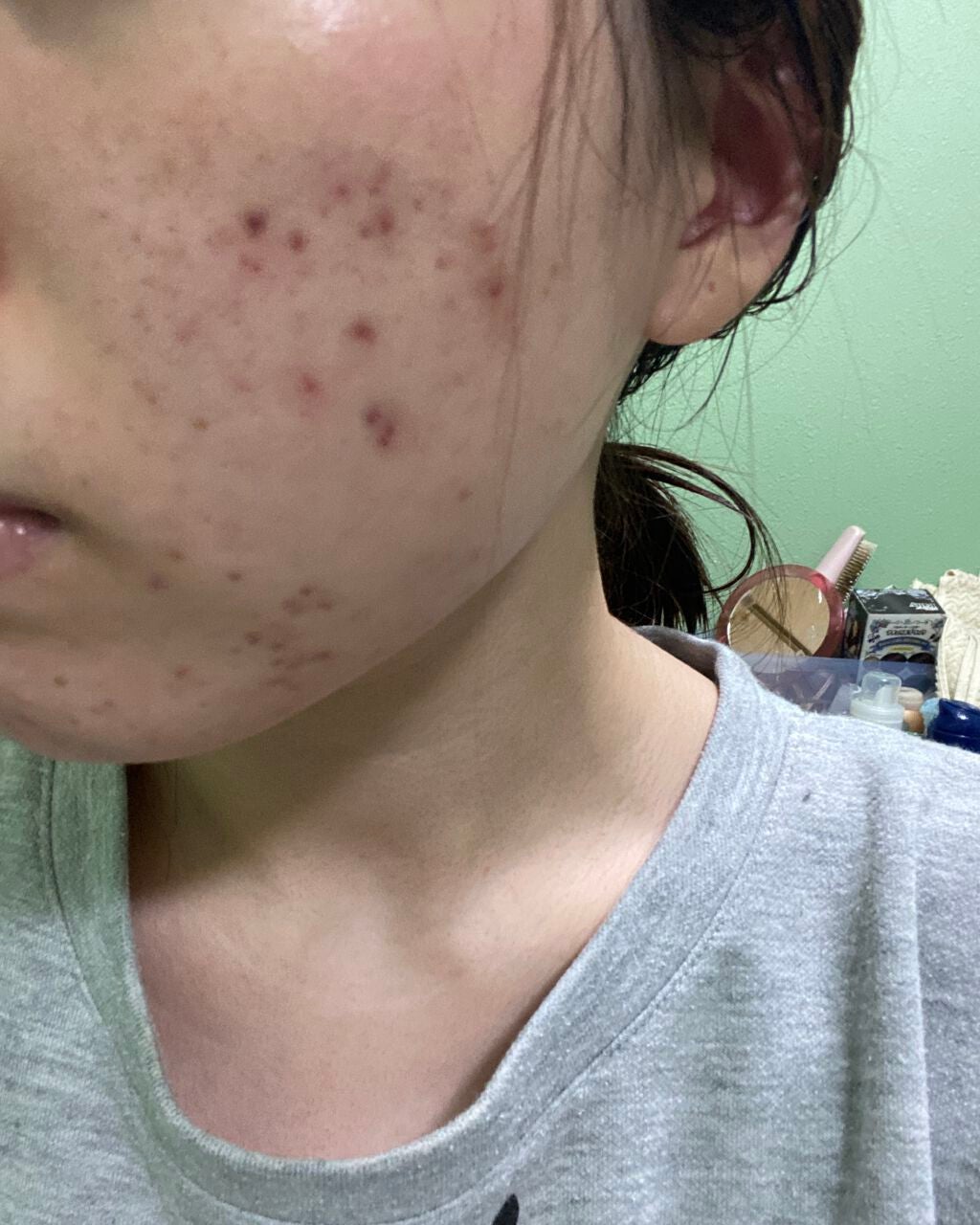 オロナインH軟膏 (医薬品)/オロナイン/その他を使ったクチコミ(4枚目)