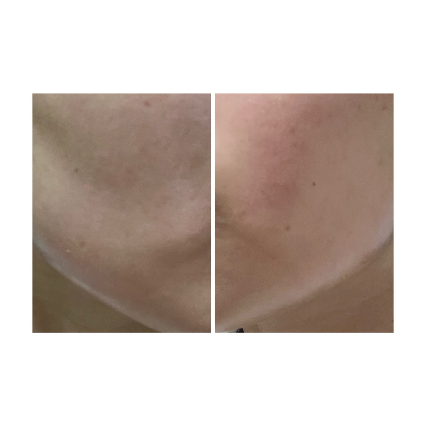 ぽむ on LIPS 「2023.9.13皮膚科に受診 エピデュオとヘパリン処方1枚目..」(5枚目)