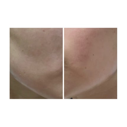 ぽむ on LIPS 「2023.9.13皮膚科に受診 エピデュオとヘパリン処方1枚目..」(5枚目)