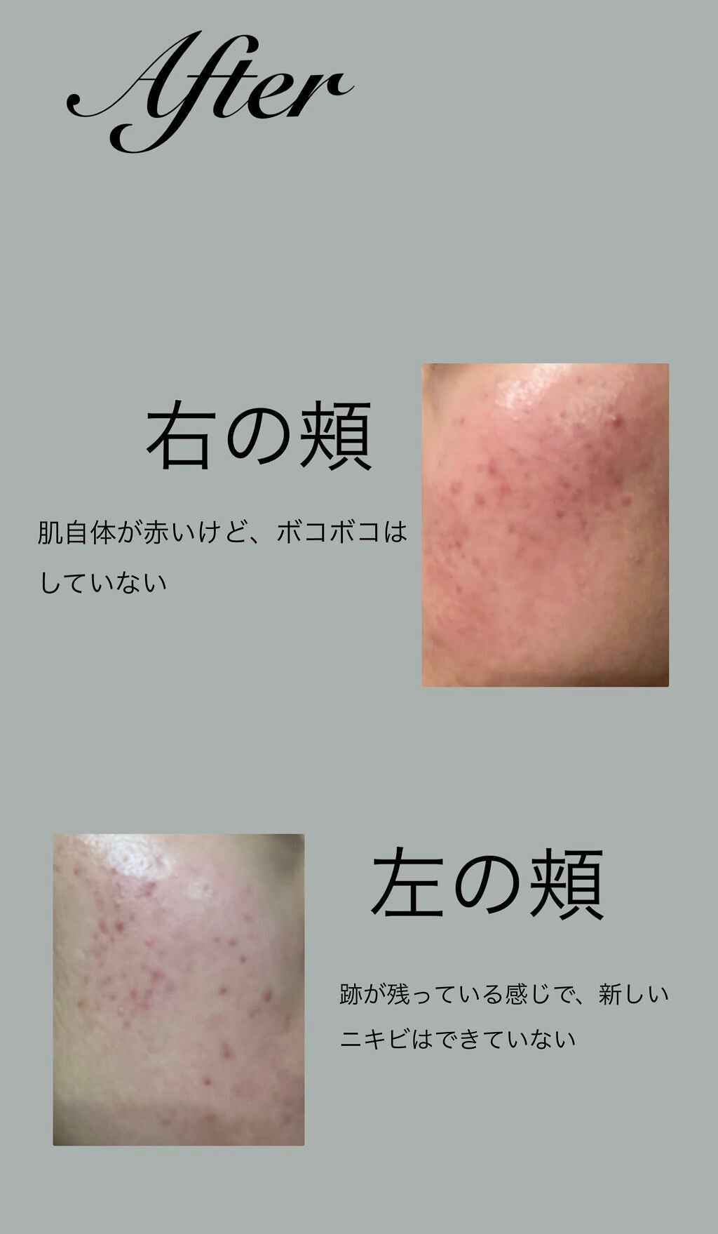 ゆるゆる on LIPS 「こんにちは〜☀️今日は皮膚科に行って貰った薬を1週間使った結果..」(4枚目)