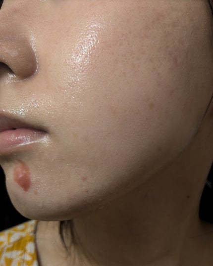 AHA 30% + BHA 2% Peeling Solution/The Ordinary/ピーリングを使ったクチコミ(2枚目)