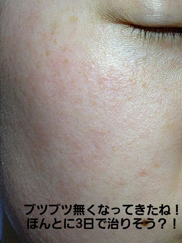 キュアレア（医薬品）/キュアレアa/その他を使ったクチコミ（2枚目）