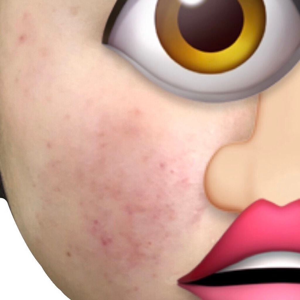 ðåã«ãªããã女ã®å on LIPS ããèã®æ©ã¿ã§ãð§ãããããããŸããããããè·¡ãèµ€ã¿ã錻ã®é»ãã¿..ãïŒ2æç®ïŒ