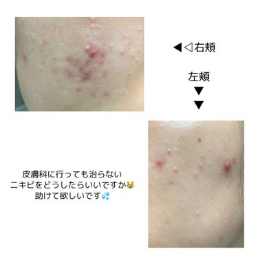 メラノCC 薬用しみ対策 美白化粧水のクチコミ「頬やおデコ、眉間、眉毛周辺、鼻、顎、首などにできるニキビにとても悩んでいます💦
皮膚科に行って.....」（1枚目）