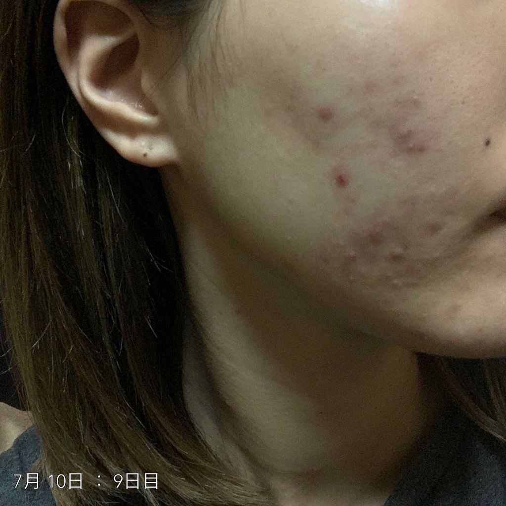 バランスケア ローション W II/d プログラム/化粧水を使ったクチコミ（3枚目）