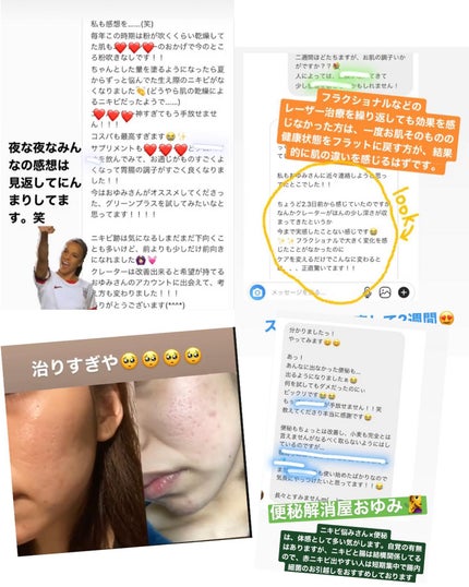 おゆみ|ニキビ・ニキビ跡ケア on LIPS 「【みんなどうやって治したの?ニキビ!しくじり先生part3】ニ..」(4枚目)