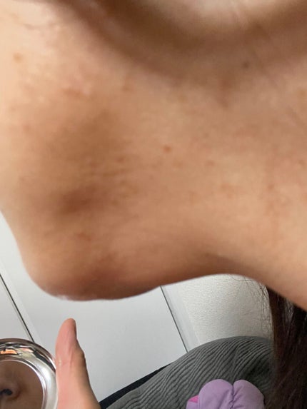 AHA 30% + BHA 2% Peeling Solution/The Ordinary/ピーリングを使ったクチコミ(2枚目)