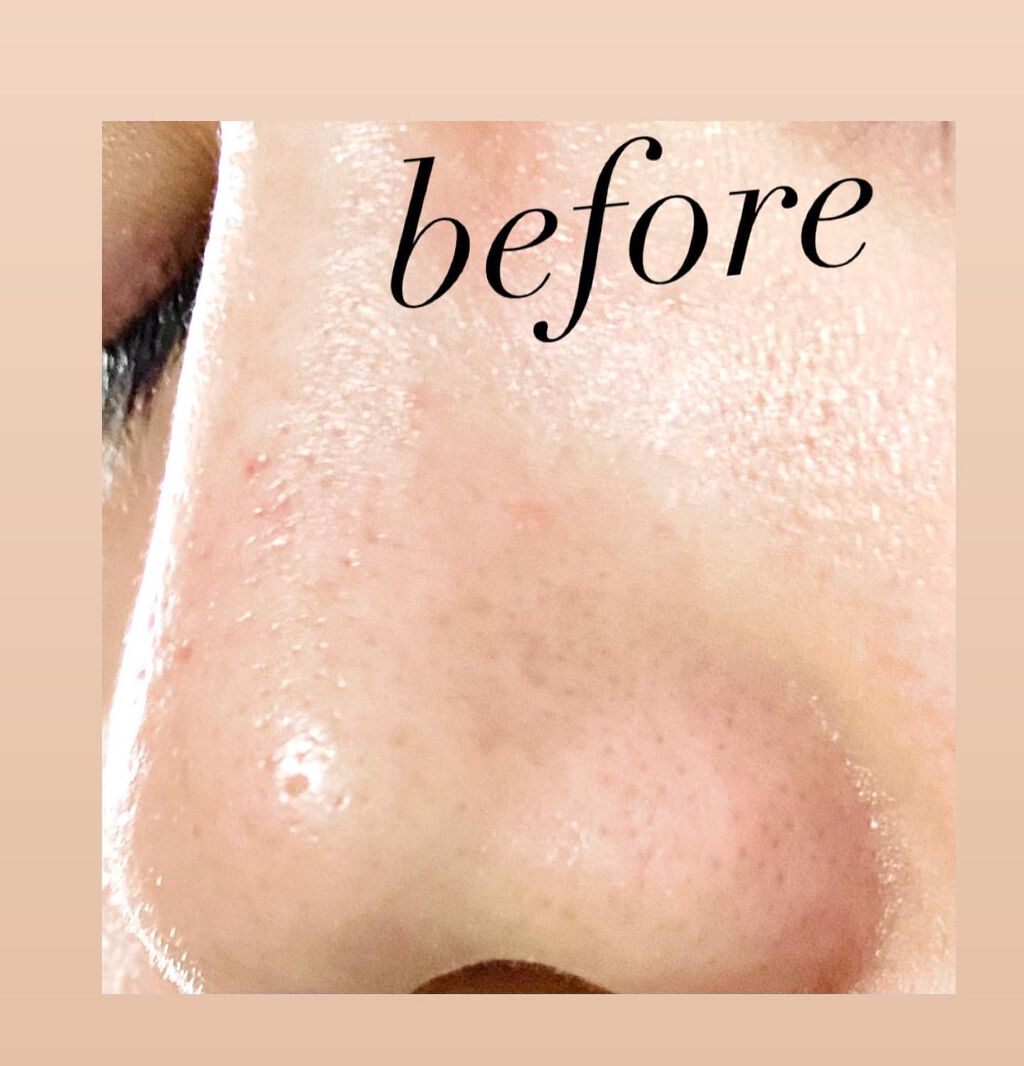 頑張らないりんごさん🍎 on LIPS 「【話題の毛穴ケア検証してみた】バズってるノーモアブラックヘッド..」(2枚目)