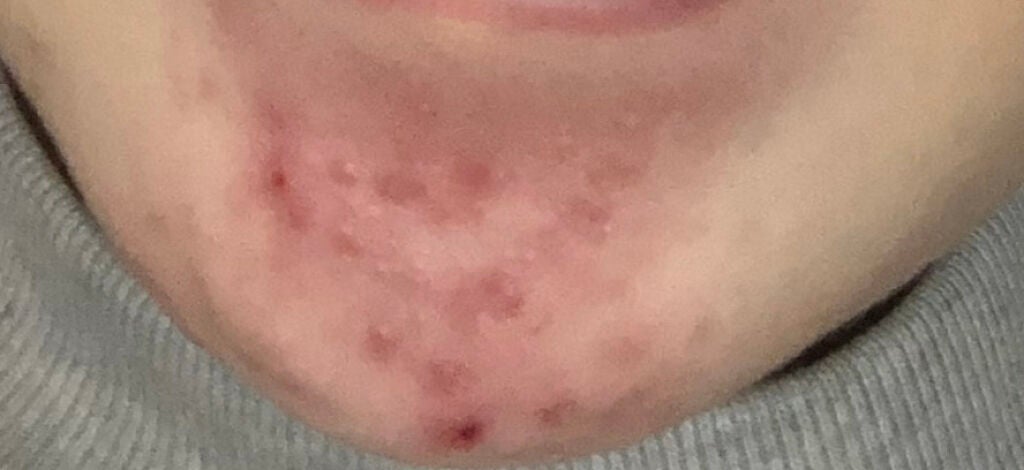 orange_beauty_6q68 on LIPS 「甘い物食べすぎてるから1番良かった時より出来物増えちゃったけど..」(2枚目)