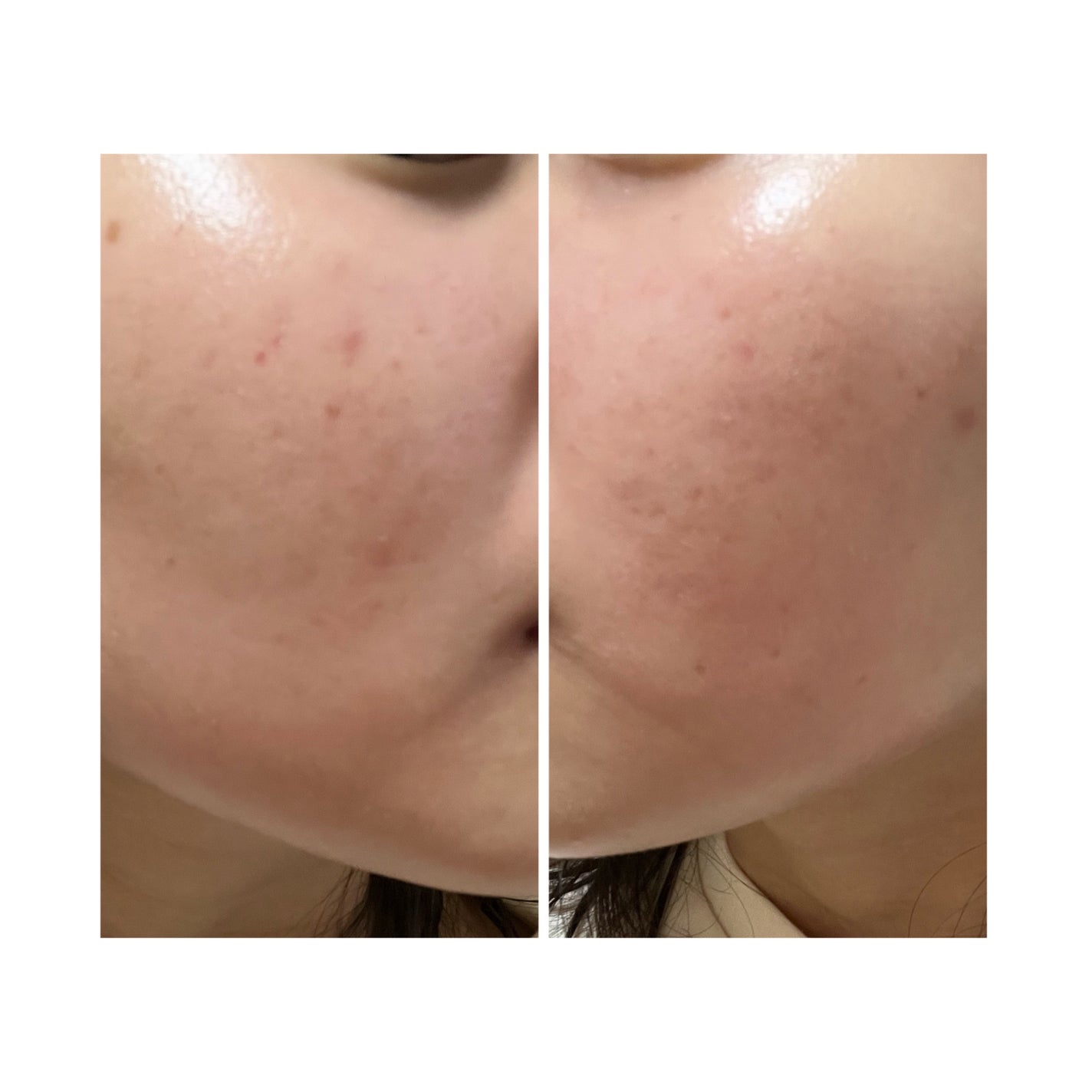 ぽむ on LIPS 「2023.9.13皮膚科に受診 エピデュオとヘパリン処方1枚目..」(2枚目)