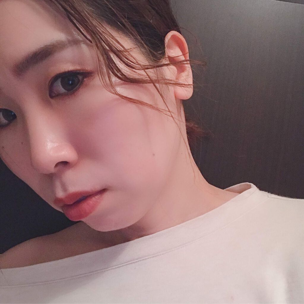 MOCA on LIPS 「【ホクロ除去体験】垢抜けには必須!*個人の体験になりますので全..」(5枚目)