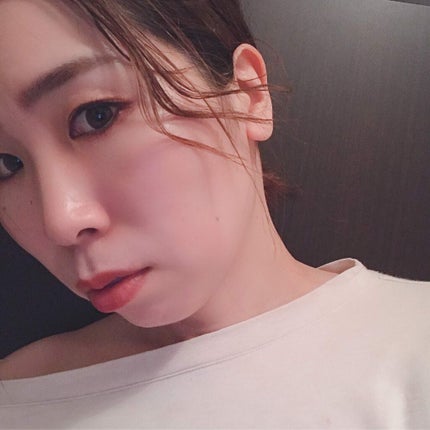 MOCA on LIPS 「【ホクロ除去体験】垢抜けには必須!*個人の体験になりますので全..」(5枚目)