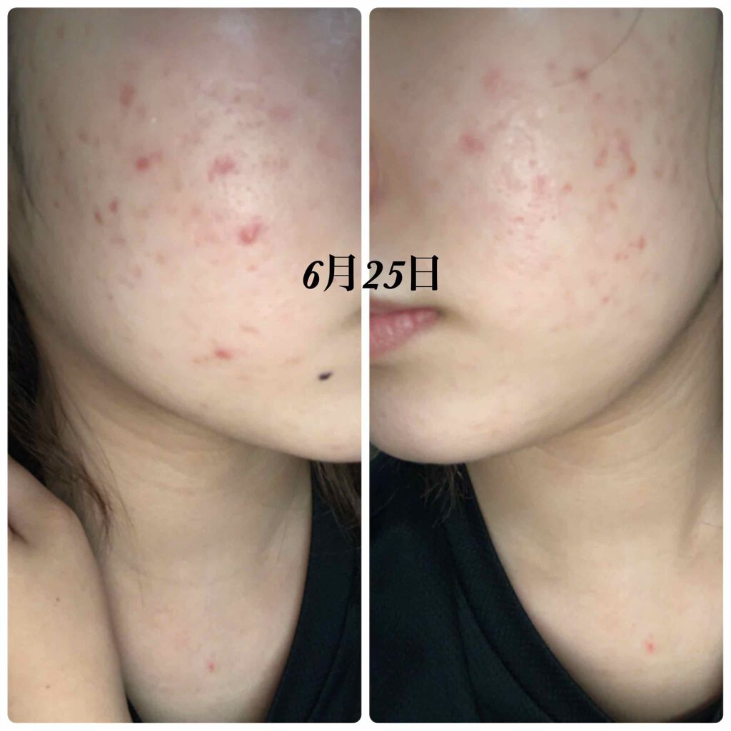 ❄️結晶❄️ on LIPS 「自分の記録用としてと同じ悩みを抱えてる方の少しでもお力になれれ..」(4枚目)