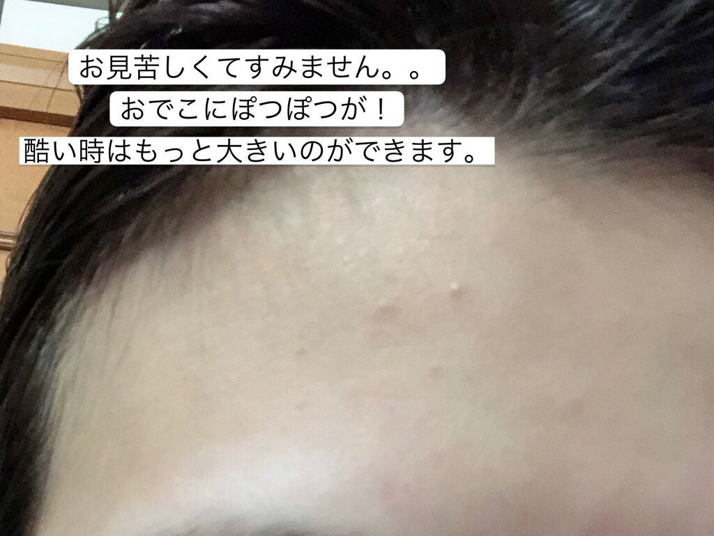 ゼロスポットパッチ/Today’s Cosme/にきびパッチを使ったクチコミ(3枚目)