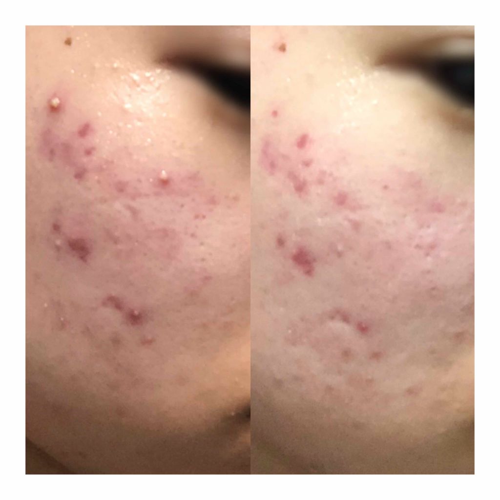 ローズヒップオイル/無印良品/フェイスオイルを使ったクチコミ（2枚目）