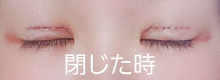 さや on LIPS 「ご覧頂きありがとうございます。ダウンタイム2日目と3日目です。..」(7枚目)