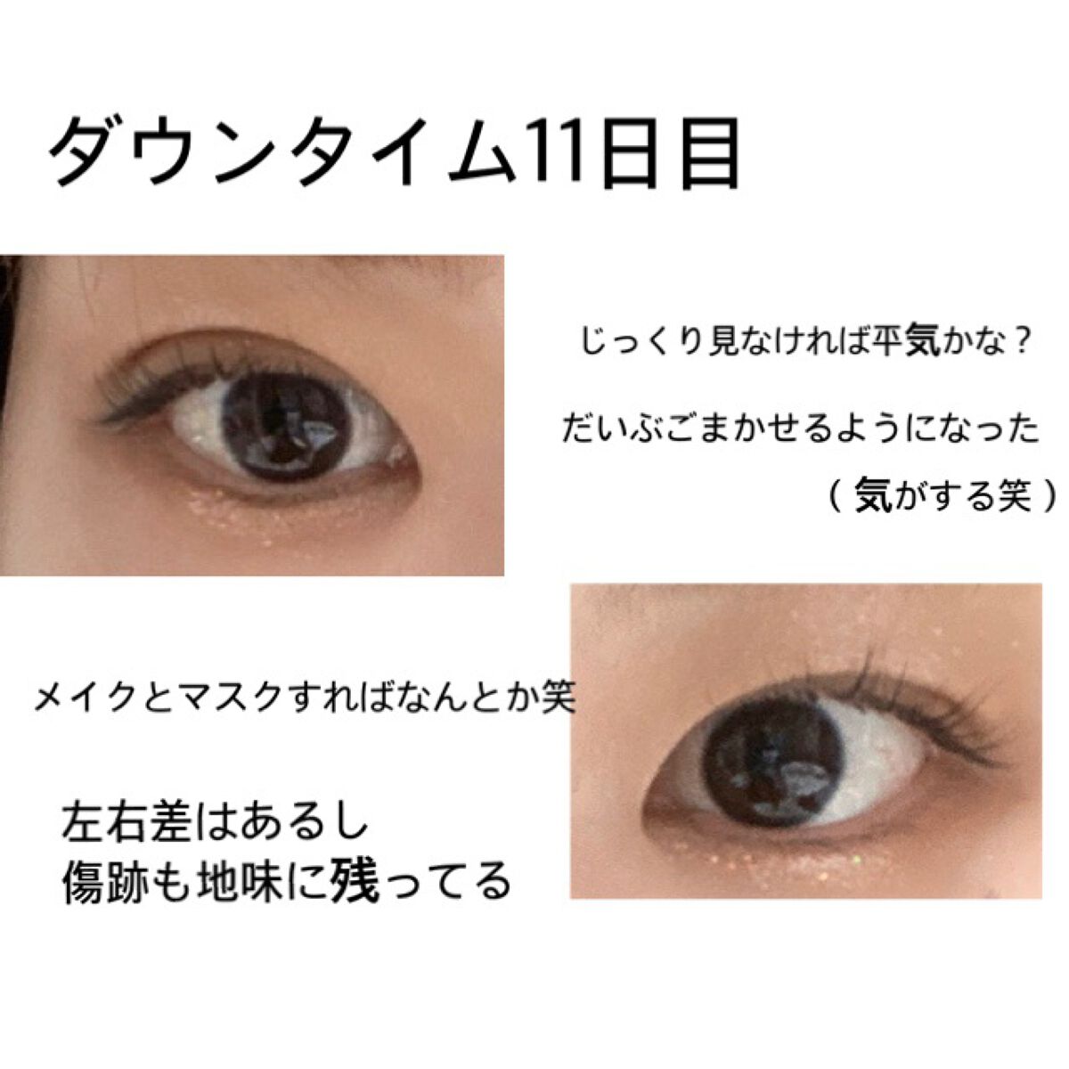 とと__フォロバ・リムバ¹⁰⁰ % on LIPS 「久々の#ダウンタイム投稿笑書くの忘れたけど、上が左目、下が右目..」(1枚目)