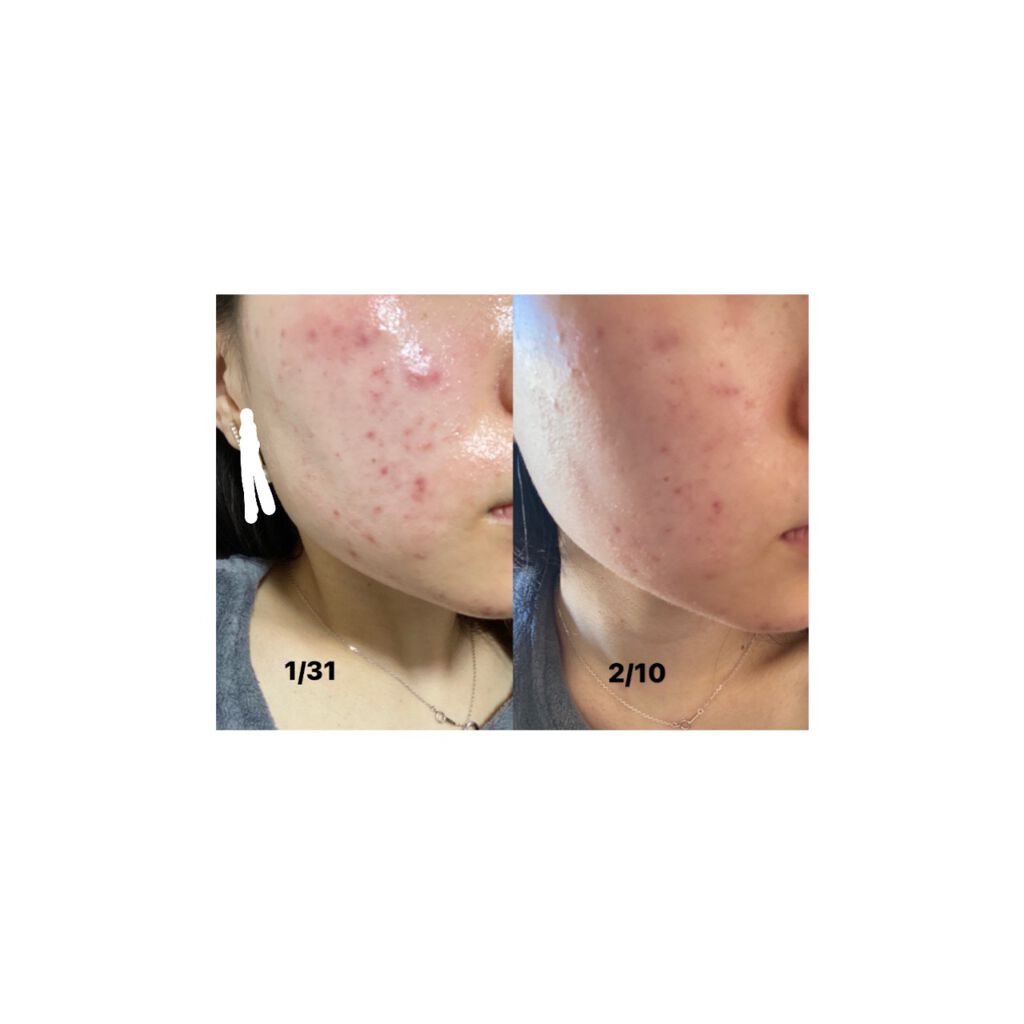 白色ワセリン(医薬品)/健栄製薬/その他を使ったクチコミ（1枚目）