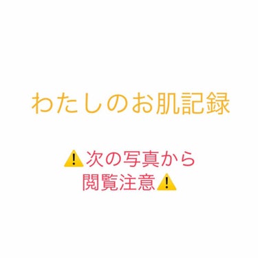 約20日ぶりに投稿します



わたしのお肌の状況が悪すぎます……

はっきり言って、ニキビ跡は変化なし！！！

なんと言ってもこのニキビ跡！！！

ほんとうらめしや👻

皮膚科で頂いたダラシンTゲル１