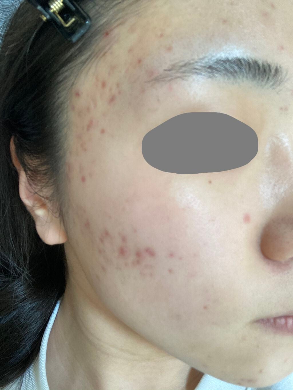 fantastic_make_9nly on LIPS 「ニキビ治療記録..」(1枚目)