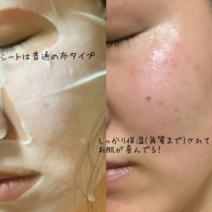 ごめんね素肌 キニナルマスク/クリアターン/シートマスク・パックを使ったクチコミ(2枚目)