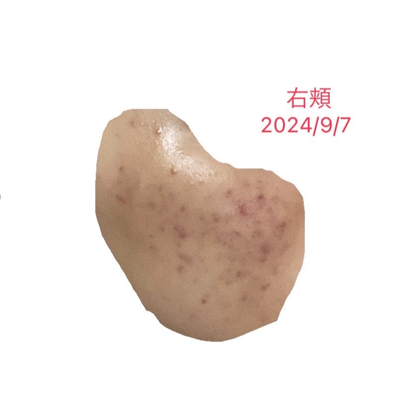 ぽよこ on LIPS 「2024/9/7ニキビの数は、先月よりは減りました。ニキビ跡は..」(1枚目)