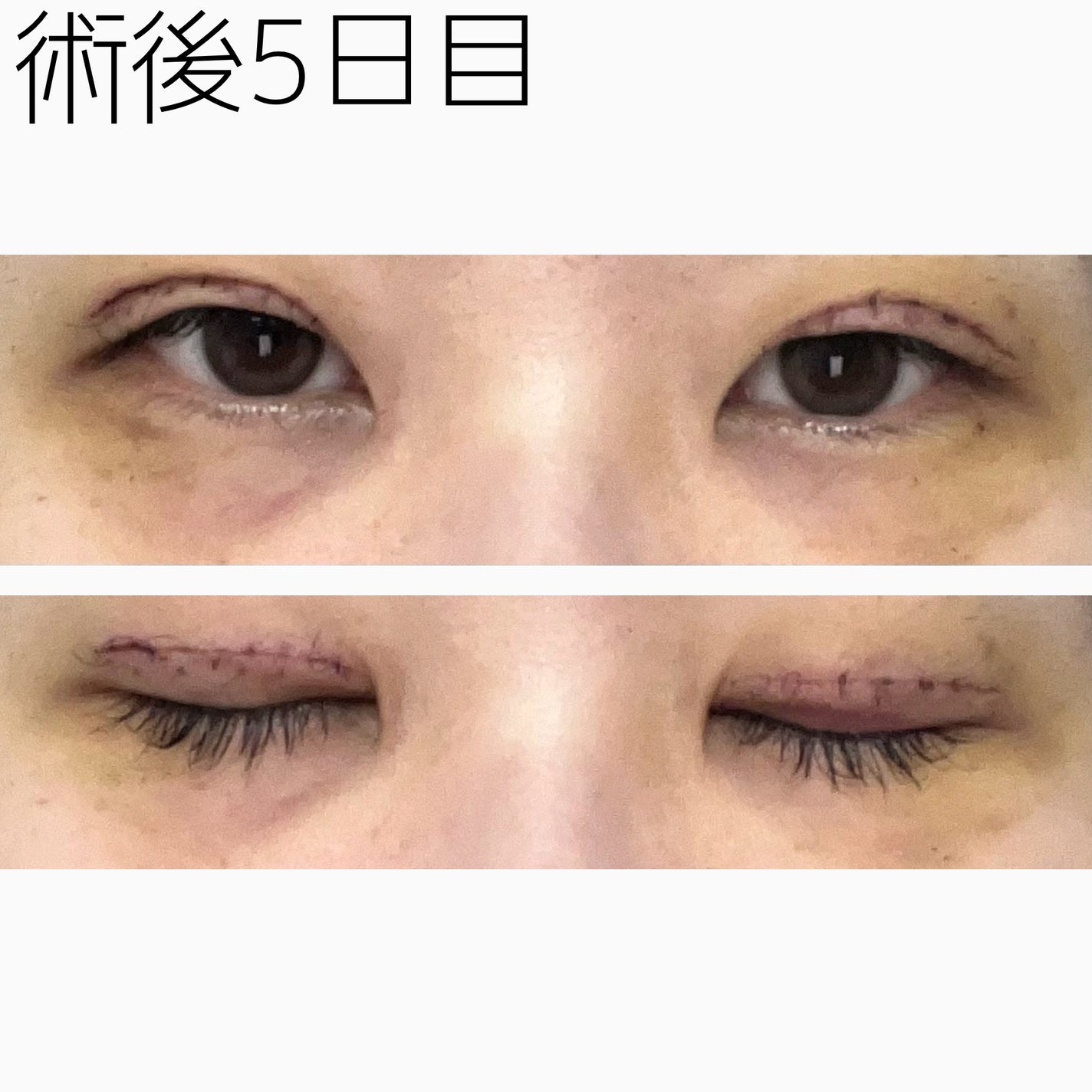 NANO@フォロバ! on LIPS 「二重整形ダウンタイム記録/かなり黄色みが強くなってきました。気..」(2枚目)