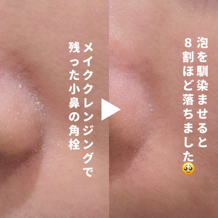 ABC-Gピールウォッシュ/ドクターケイ/泡洗顔を使ったクチコミ(9枚目)