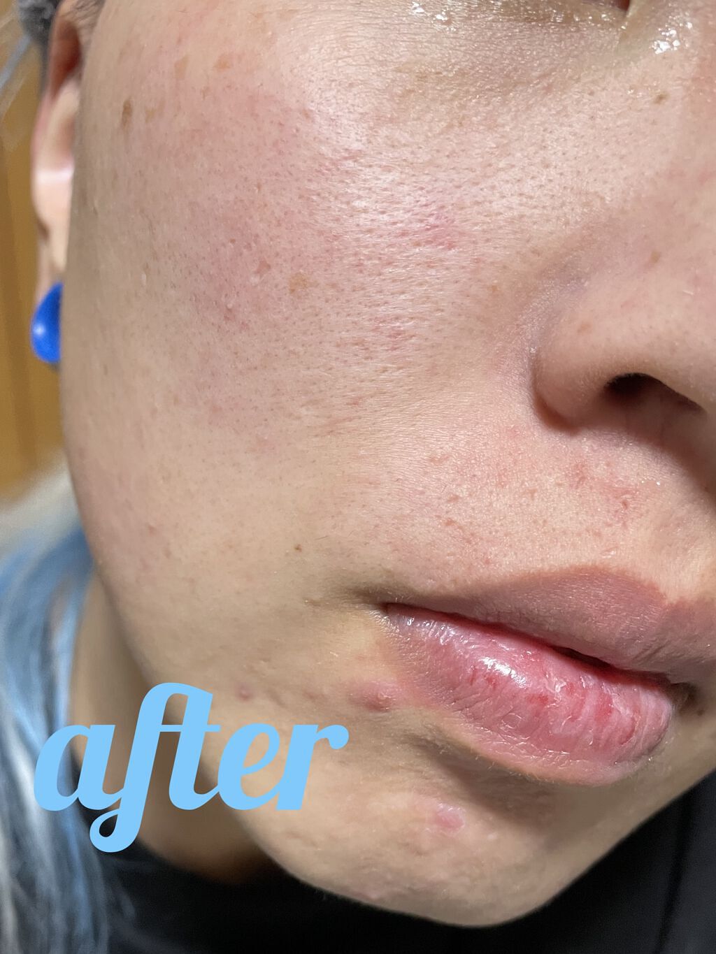 ベリーお元気？/ラッシュ/洗い流すパック・マスクを使ったクチコミ（3枚目）