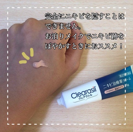 ニキビ治療薬クリーム (医薬品) 肌色/クレアラシル/その他を使ったクチコミ(3枚目)