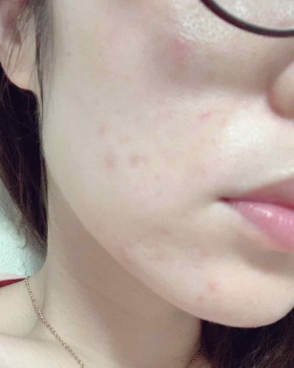 薬用 クリアローション M(しっとりタイプ)/オルビス/化粧水を使ったクチコミ(1枚目)