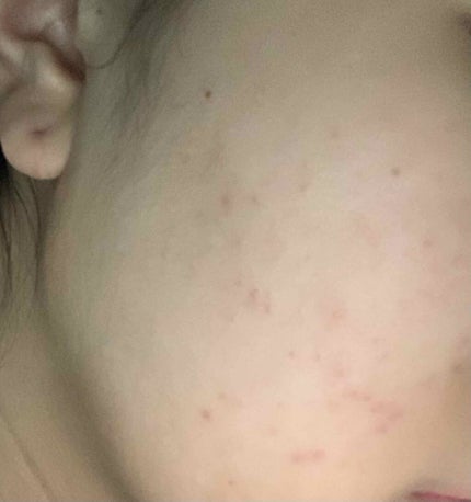 ニキビあとケアジェル/アットノン/その他スキンケアを使ったクチコミ(3枚目)