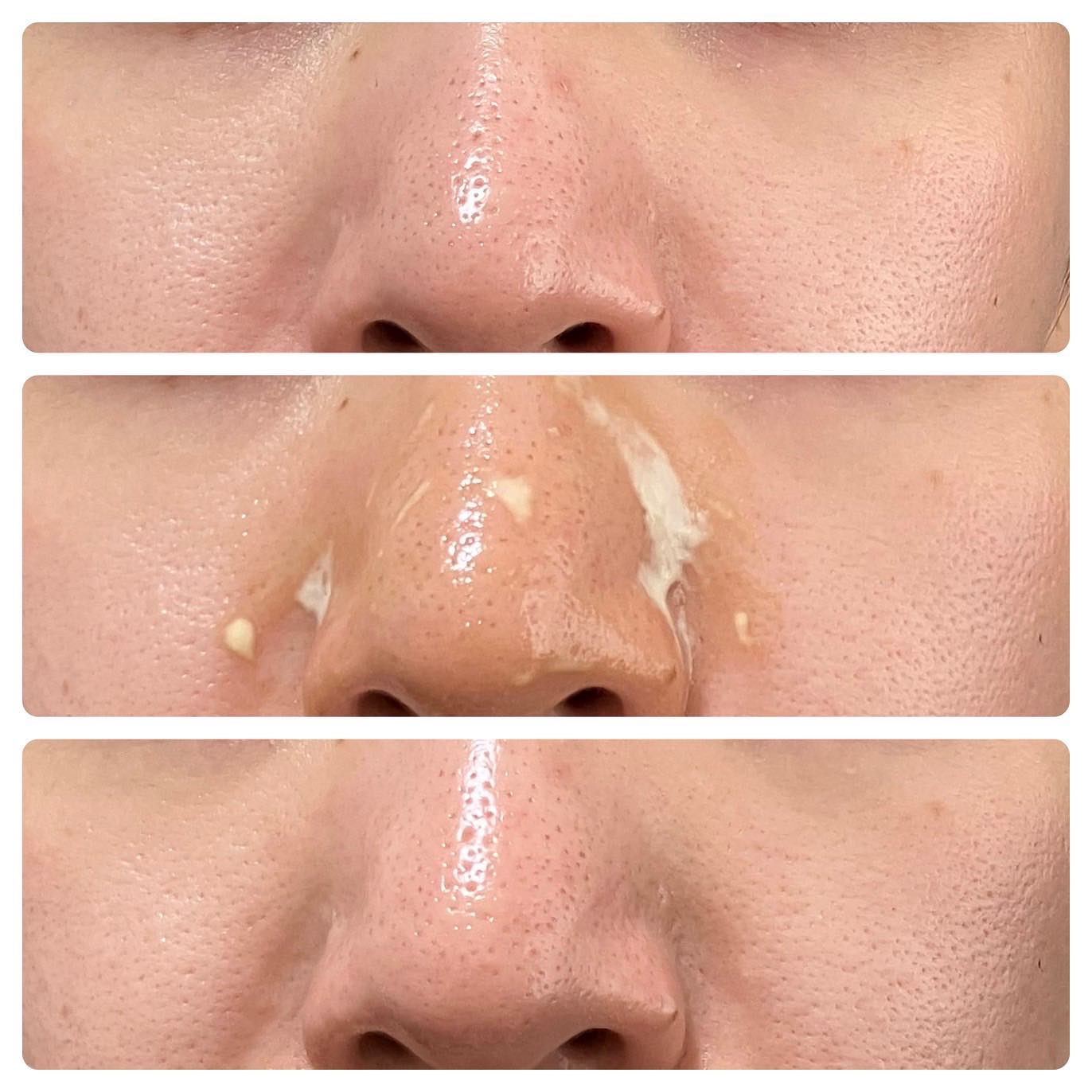 レディブラン 薬用美白シミキールパックC/シーヴァ/ピーリングを使ったクチコミ（3枚目）