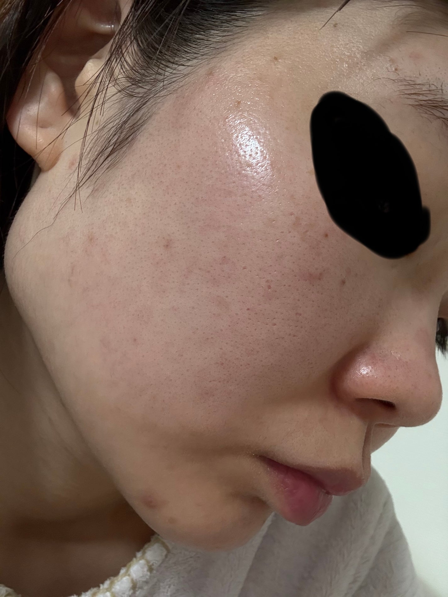 maa on LIPS 「コロナ禍で肌が荒れて、ニキビ大量発生から早4年過ぎこの毛穴開き..」(1枚目)