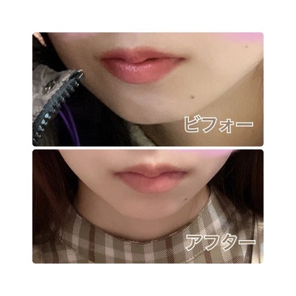 ヒアルロン酸注入/プラウドクリニック/その他を使ったクチコミ(2枚目)