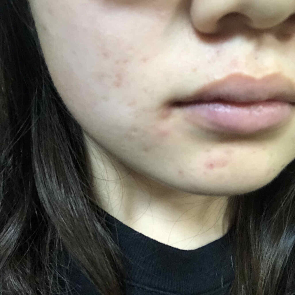 薬用しみ対策 美白化粧水 しっとりタイプ/メラノCC/化粧水を使ったクチコミ（2枚目）