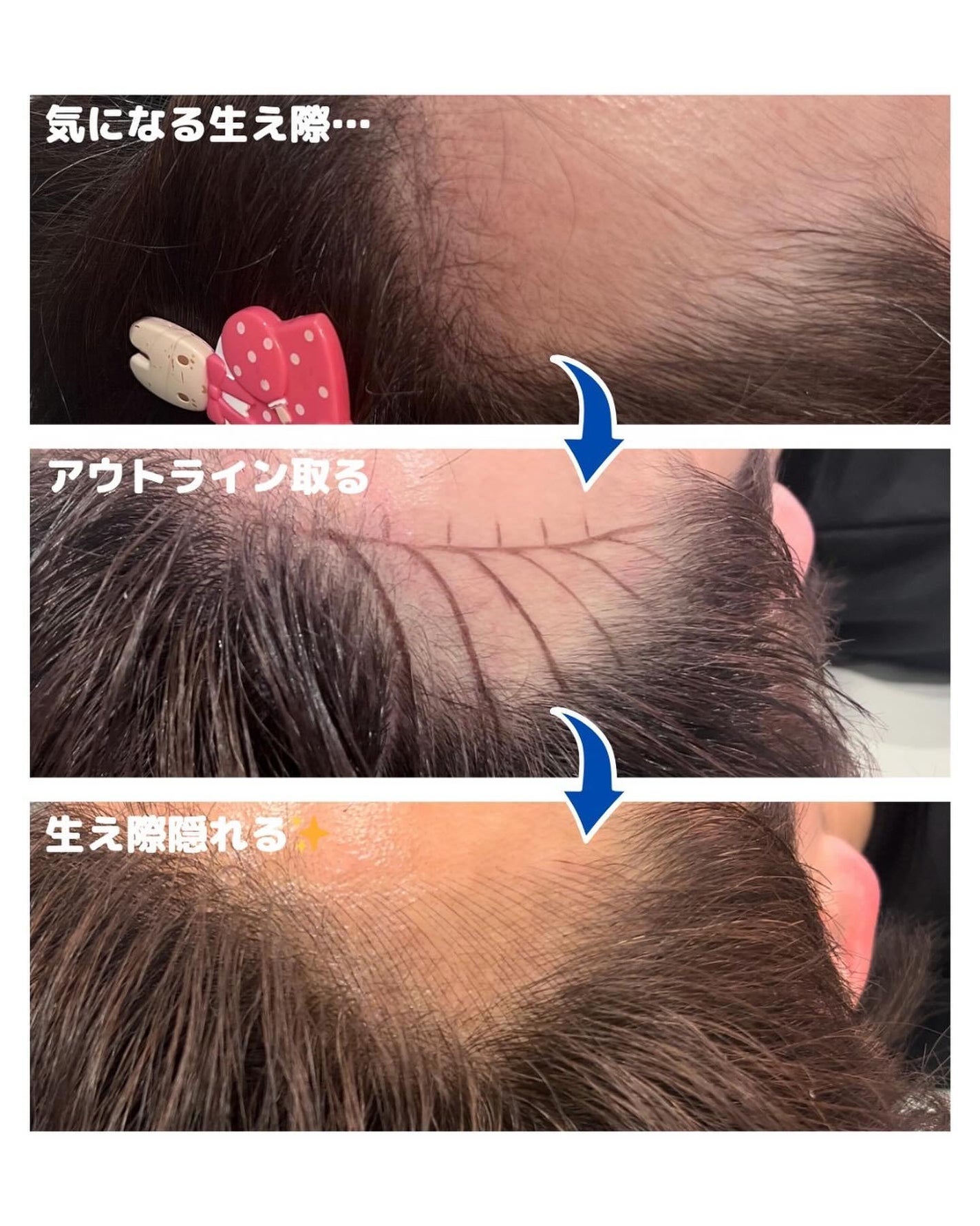 ヒロキ|40歳の美容家 ヘアケア スキンケア on LIPS 「やりました!美容医療レポ。生え際アートメイク🪡 昔から生え際に..」(3枚目)