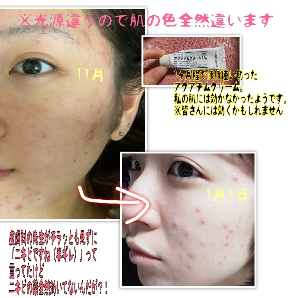 アクアチムローション、アクアチムクリーム(医薬品)/大塚製薬/その他を使ったクチコミ（2枚目）