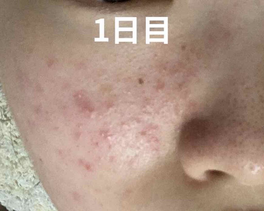 FDR アクネケア ジェル乳液/ファンケル/乳液を使ったクチコミ(2枚目)