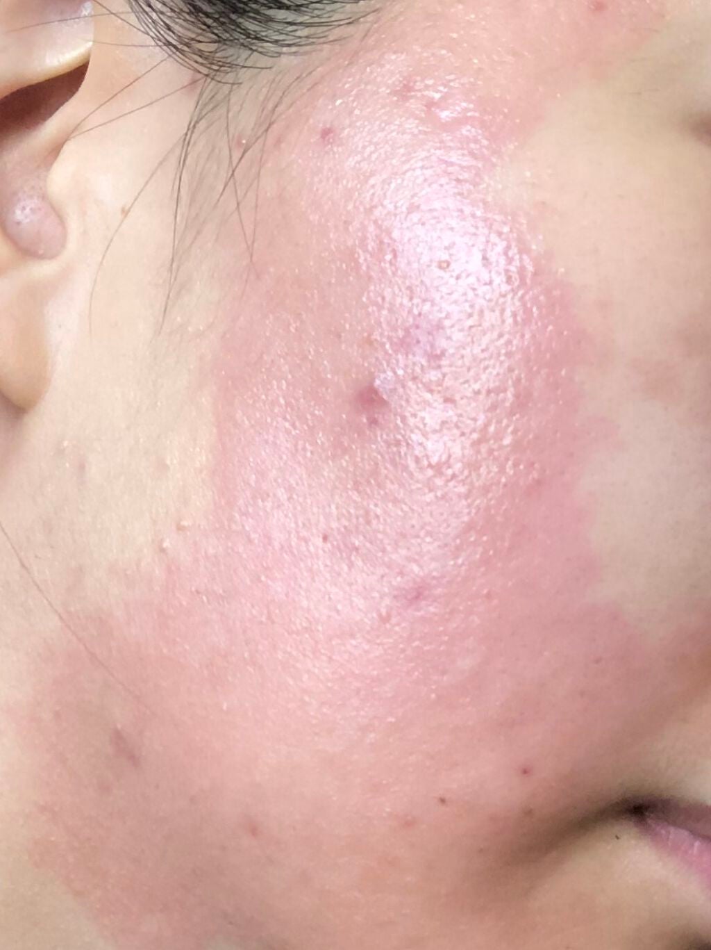 ちー on LIPS 「メモ用です。。今日朝起きて見るとまた赤みが増してました…。見る..」(2枚目)